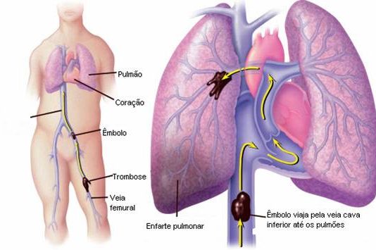 emboliaPulmonar