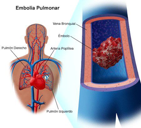 embolia