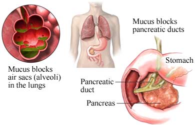 Fibrosis