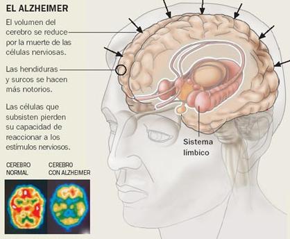 enfermedad-de-Alzheimer