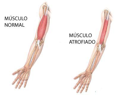 Distrofias Musculares; Distrofia Muscular