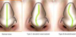 tabique-nasal-desviado