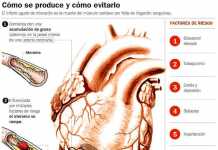 infarto