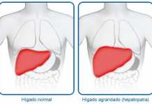 higado-agrandado